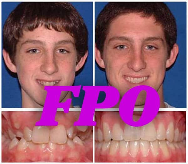 traditionalbracescase8bildb WOW Orthodontics