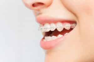 Clear braces in Brentwood Wow Orthodontics, Invisalign, Clear Braces, Meta Braces, Clear Aligners, Retainers, Mouth Guards, Traditional Braces, Invisalign Provider Brentwood Tennessee 37027, Orthodontics Braces Invisalign for Teens, Orthodontics Braces Invisalign for Adults, Orthodontics Braces Invisalign for kids, Orthodontics Braces Invisalign for Children, Emergency Orthodontist Brentwood, Emergency Orthodontics, Same Day Orthodontics in Brentwood Tennessee, Dr. Wendy Oakes Wilhelm, Orthodontic Specialist, 615-376-0969, 214 Ward Circle Ste 1100 A, Brentwood, TN 37027, Orthodontist in Brentwood Tennessee