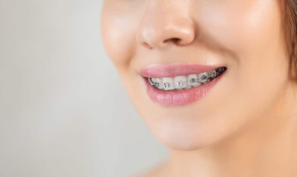 Alternatives to Braces Brentwood