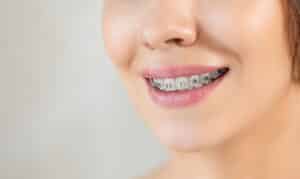 Alternatives to Braces Brentwood