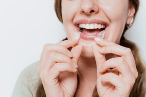 clear aligners Brentwood