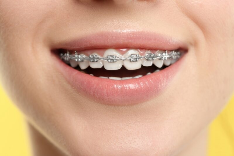 Metal Braces Brentwood