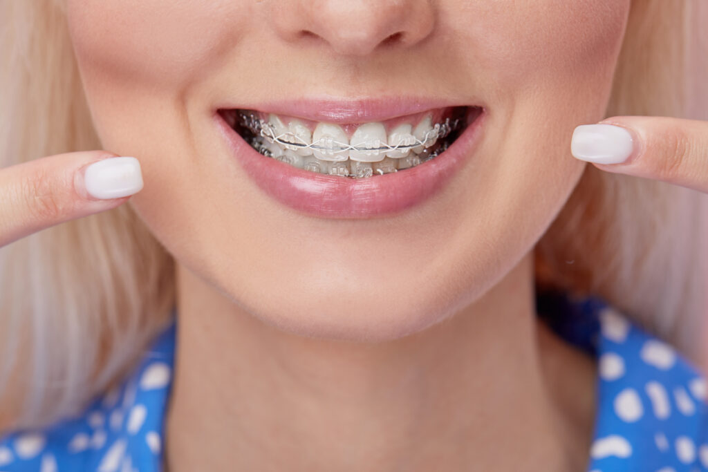 Clear Braces in Brentwood